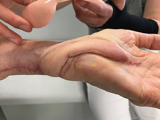 2017-07-13_Erste_Anprobe_Silikonformteil__3_.JPG  