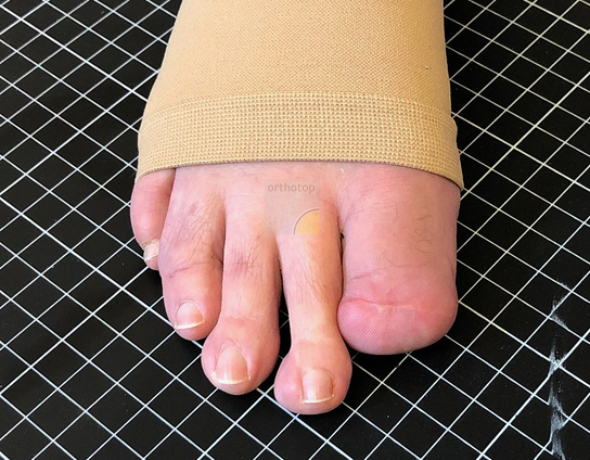 Amputation_D1__1_.JPG  